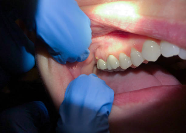 Best Dental Abscess Treatment in Janesville, MN