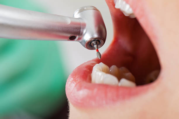 Best Knocked-Out Tooth (Avulsed Tooth) Treatment in Janesville, MN